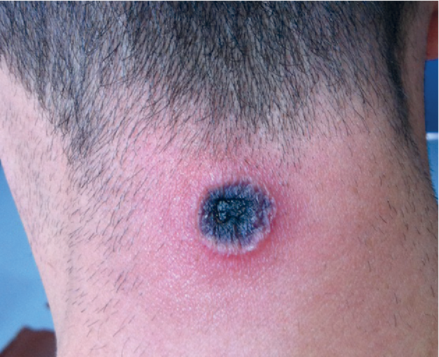 Human anthrax case reported in western Mongolia