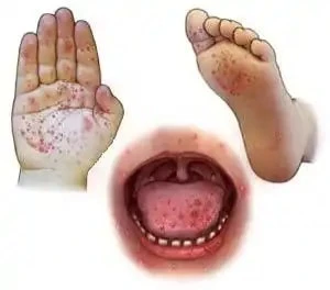 Narraville Primary Confirms Hand, Foot and Mouth Disease Cases